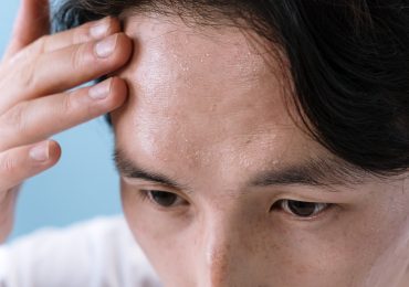 Trądzik skóry głowy - dlaczego się pojawia i jak się go skutecznie pozbyć?