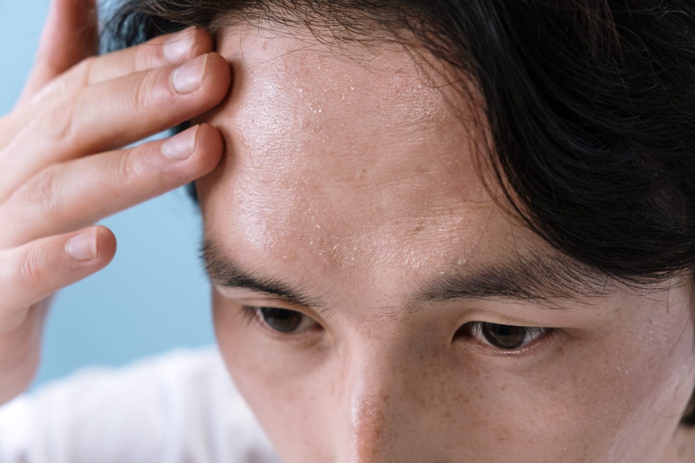 Trądzik skóry głowy – dlaczego się pojawia i jak się go skutecznie pozbyć?