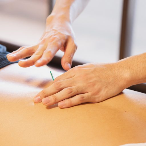 Akupunktura – czym jest i dlaczego warto z niej korzystać?
